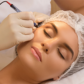 MICRODERMABRASION THERMOCOAGULATION